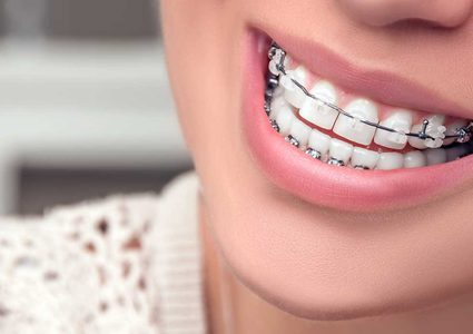 طرق العناية بنظافة الاسنان خلال وضع التقويم.. تعرفوا عليها