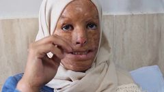 هداية الأسطل غزية تبحث عن أمل يعيد لها ملامح طمستها الحروق