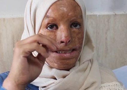 هداية الأسطل غزية تبحث عن أمل يعيد لها ملامح طمستها الحروق