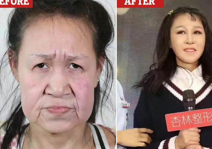 الصين..مراهقة تجري عملية جراحية للتخلص من وجهها "الستيني"
