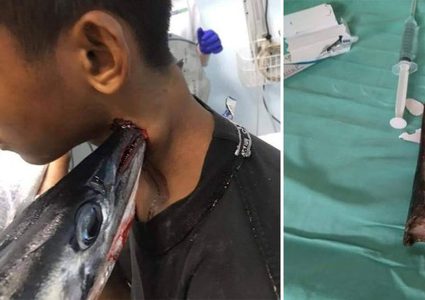 إندونيسيا.. سمكة إبرة تباغت طفل وتطعنه في رقبته