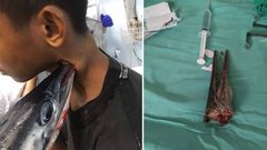 إندونيسيا.. سمكة إبرة تباغت طفل وتطعنه في رقبته