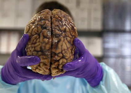 أطباء يكتشفون مفاجأة عمرها 10 سنوات