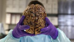 أطباء يكتشفون مفاجأة عمرها 10 سنوات