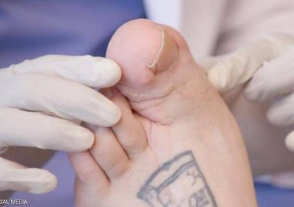 شاب أمريكي تتحول حياته لمحنة قاسية بسبب إصبع قدمه !