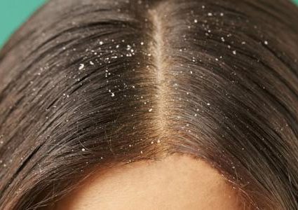 أبرز أسباب المعاناة من مشكلة القشرة في الشعر