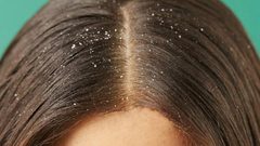 أبرز أسباب المعاناة من مشكلة القشرة في الشعر