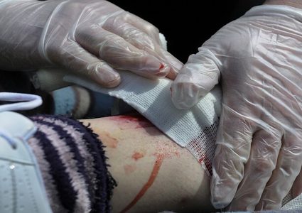 لماذا لا ينصح بصب الكحول على الجرح؟