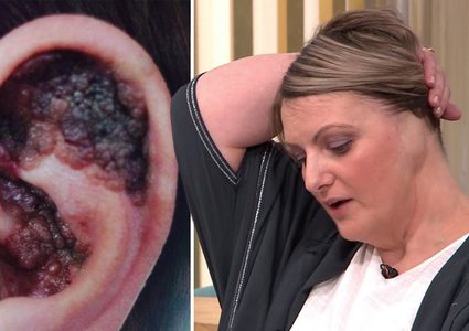 سيدة بريطانية تخسر أذنها بسبب "حمامات الشمس" !