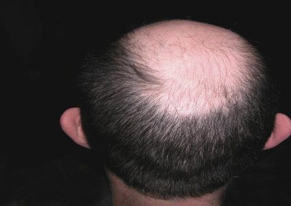 بقع على رأس أسترالي تكشف عن مرض خطير