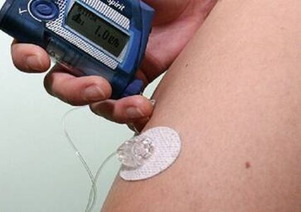 علماء كندا يبتكرون بنكرياسا اصطناعيا