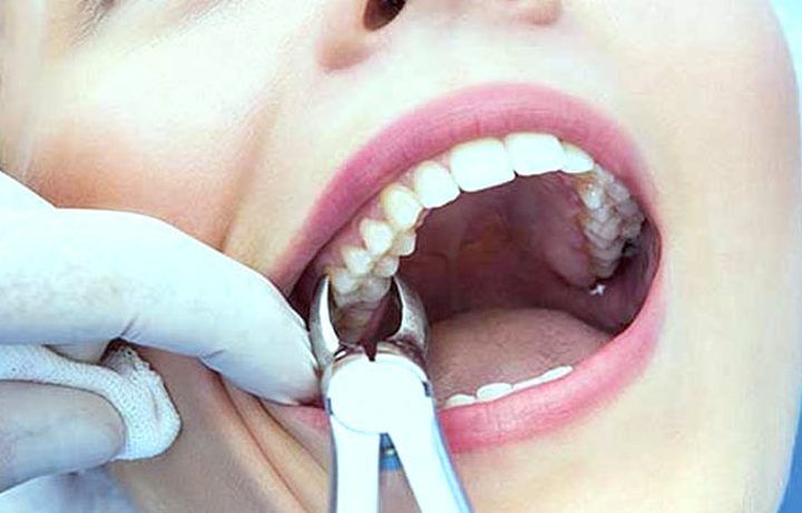 ما هي الأطعمة التي عليك تناولها بعد خلع الأسنان ؟