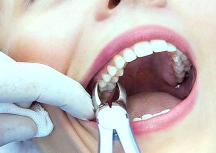 ما هي الأطعمة التي عليك تناولها بعد خلع الأسنان ؟