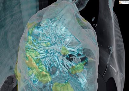 شاهد كيف يدمر فيروس كورونا رئتي المريض ؟