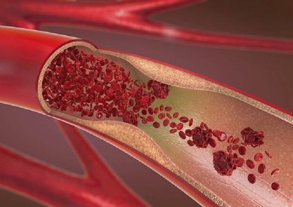 تصلب الشرايين يتسارع بعد سن الأربعين