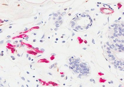 ما هو سبب ارتفاع نسبة الإصابة بسرطان الثدي ؟