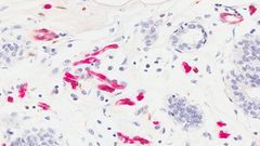 ما هو سبب ارتفاع نسبة الإصابة بسرطان الثدي ؟