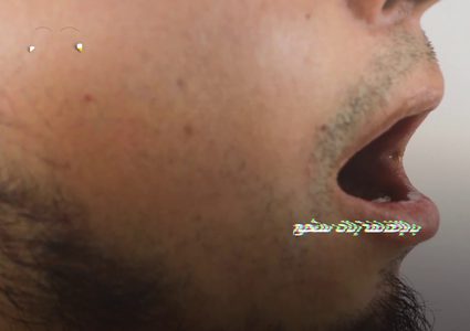 خطير .. أعراض جديدة لفيروس كورونا تعرف عليها