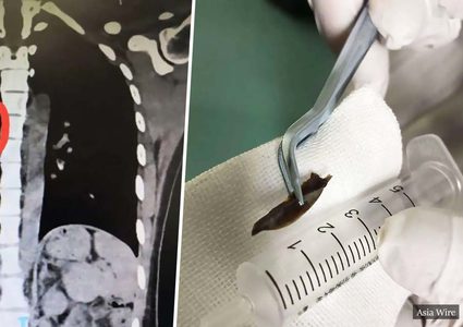 فتاة صينية تكتشف أنها تعاني من السعال المستمر بسبب "عظم الدجاج"