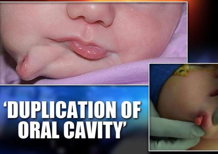 ولادة طفلة بفمين منفصلين بولاية ساوث كارولينا الأمريكية