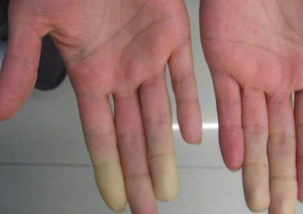 ما هي ظاهرة رينود؟