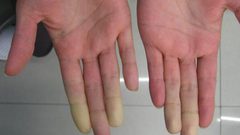 ما هي ظاهرة رينود؟