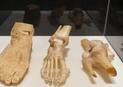 ابتكار "أسمنت" لترميم شقوق العظام