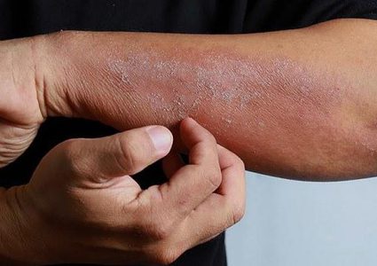 دراسة: الطفح الجلدي هو أحد أعراض مرض كوفيد-19