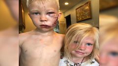 مواقع التواصل تتداول قصة شجاعة طفل أنقذ شقيقته من هجوم كلب شرس