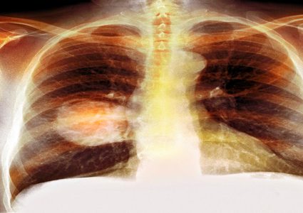 اكتشاف مادة تمنع نمو أخطر أنواع الأورام الخبيثة