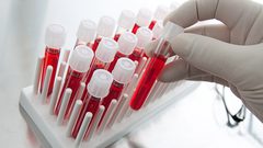 تطوير فحص دم جديد للكشف عن الزهايمر