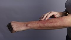 آفات جلدية لدى مرضى "كوفيد-19" قد تكون علامة على مشكلة صحية