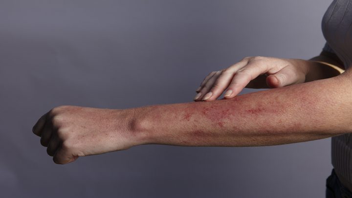 آفات جلدية لدى مرضى "كوفيد-19" قد تكون علامة على مشكلة صحية