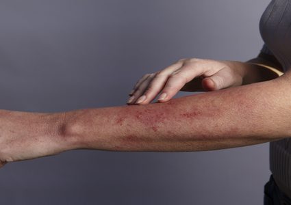 آفات جلدية لدى مرضى "كوفيد-19" قد تكون علامة على مشكلة صحية