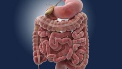 تحذير.. هذه الأعراض تنذر باحتمال الإصابة بسرطان الأمعاء