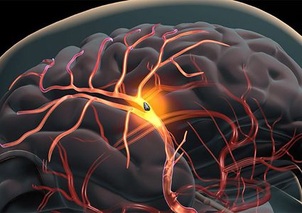 دراسة: أصحاب البشرة السوداء أكثر عرضة للسكتة الدماغية