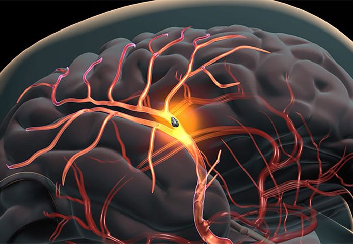 دراسة: أصحاب البشرة السوداء أكثر عرضة للسكتة الدماغية