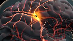 دراسة: أصحاب البشرة السوداء أكثر عرضة للسكتة الدماغية