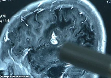 شاب صيني يعاني من مشكلة صادمة بسبب تناوله الثعابين والضفادع