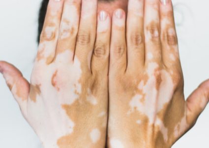 مختص يتحدث عن فرص علاج مرض البهاق