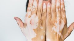 مختص يتحدث عن فرص علاج مرض البهاق