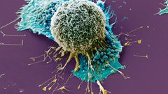 متى يجب عليك الذهاب لطبيب الأورام ؟