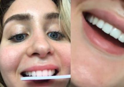 تحدي تقويم الأسنان بالمبرد يثير الجدل على منصة التيك توك