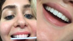 تحدي تقويم الأسنان بالمبرد يثير الجدل على منصة التيك توك