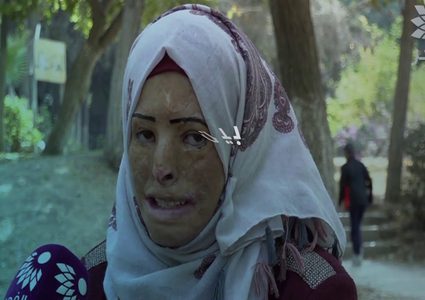 فتاة من غزة تبحث عن أمل يعيد لها ملامح طمستها الحروق