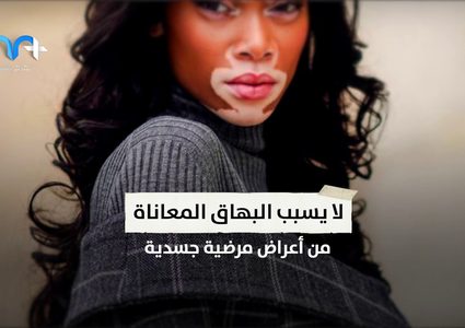 أبرز الحقائق حول مرض البهاق الجلدي