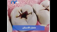 علامات واضحة تؤكد نقص الكالسيوم في جسمك