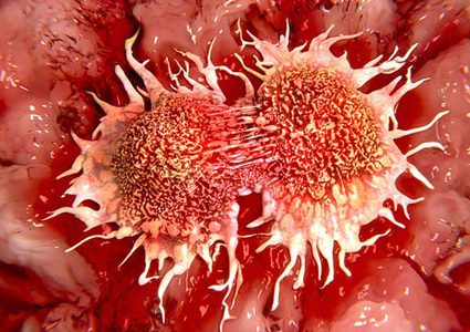 أبرز أعراض مرض سرطان الفم القاتل