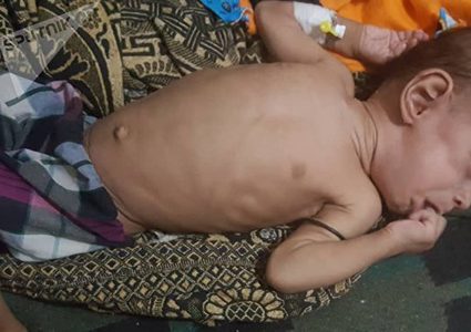 الأمم المتحدة:مليوني طفل باليمن بحاجة للعلاج من سوء التغذية الحاد