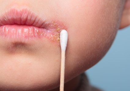 تحذير.. فيروس الهربس قادر على تدمير أدمغة الأجنة